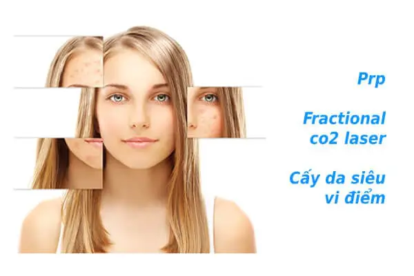 'Lấp đầy' sẹo rỗ lâu năm không khó như bạn tưởng