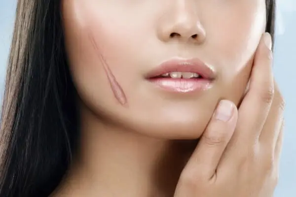 'Lấp đầy' sẹo rỗ lâu năm không khó như bạn tưởng