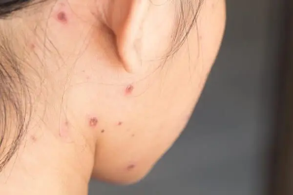 'Lấp đầy' sẹo rỗ lâu năm không khó như bạn tưởng