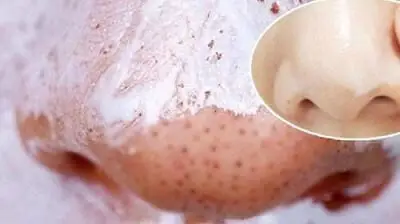 Chúng ta có thể loại bỏ mụn đầu đen nhanh chóng bằng bàn chải đánh răng.